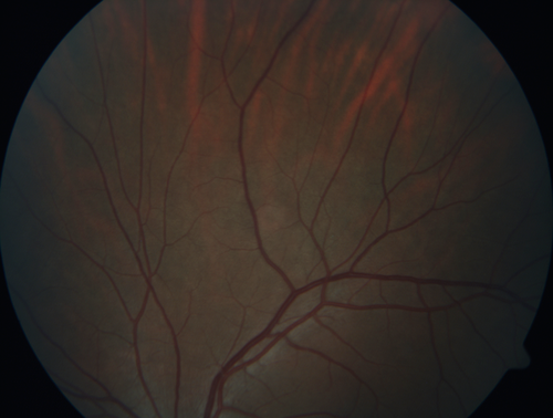 White Retinal Artiole Left eye - Inferotemporal
31 year old female with migraines and headaches for the last 12-13 years.  Sometimes she gets the visual symptoms with the migraine.  When she gets the migraines the pain is on the left side of her head.  She gets the problem a few times a month, sometimes more.  They usually last 5-6  hours. She has not had a permanent vision change.  When she gets a vision change there are spotty dots of blue neon lights in her vision.  With her glasses her two eyes are about the same.  VA 20/16 in Each Eye

