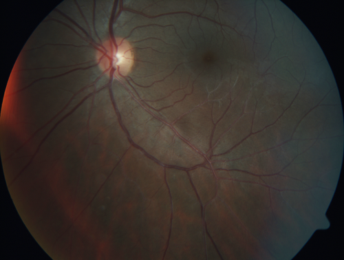 White Retinal Artiole Left eye - Inferotemporal
31 year old female with migraines and headaches for the last 12-13 years.  Sometimes she gets the visual symptoms with the migraine.  When she gets the migraines the pain is on the left side of her head.  She gets the problem a few times a month, sometimes more.  They usually last 5-6  hours. She has not had a permanent vision change.  When she gets a vision change there are spotty dots of blue neon lights in her vision.  With her glasses her two eyes are about the same.  VA 20/16 in Each Eye
