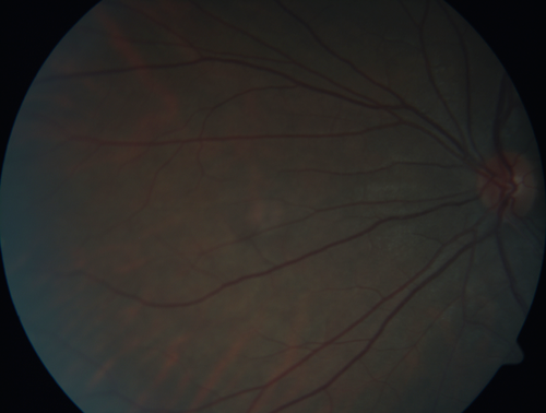 White Retinal Artiole Left eye - Inferotemporal
31 year old female with migraines and headaches for the last 12-13 years.  Sometimes she gets the visual symptoms with the migraine.  When she gets the migraines the pain is on the left side of her head.  She gets the problem a few times a month, sometimes more.  They usually last 5-6  hours. She has not had a permanent vision change.  When she gets a vision change there are spotty dots of blue neon lights in her vision.  With her glasses her two eyes are about the same.  VA 20/16 in Each Eye
