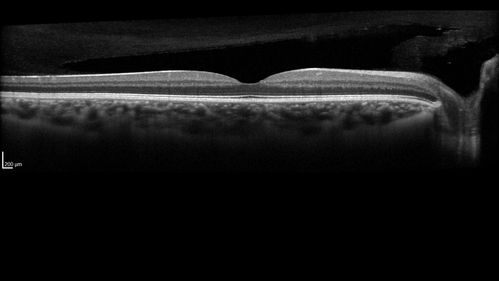 White Retinal Artiole Left eye - Inferotemporal
31 year old female with migraines and headaches for the last 12-13 years.  Sometimes she gets the visual symptoms with the migraine.  When she gets the migraines the pain is on the left side of her head.  She gets the problem a few times a month, sometimes more.  They usually last 5-6  hours. She has not had a permanent vision change.  When she gets a vision change there are spotty dots of blue neon lights in her vision.  With her glasses her two eyes are about the same.  VA 20/16 in Each Eye
