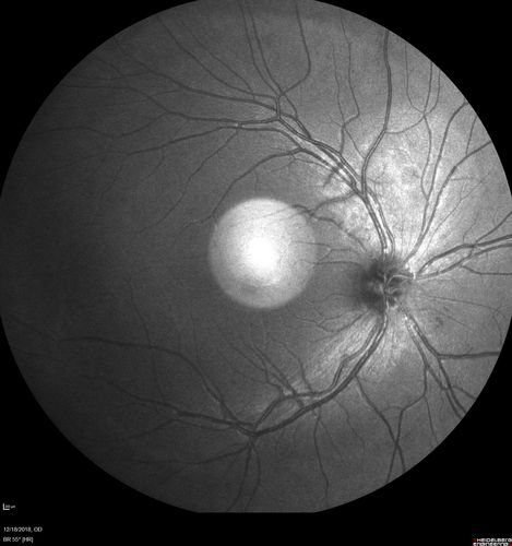 White Retinal Artiole Left eye - Inferotemporal
31 year old female with migraines and headaches for the last 12-13 years.  Sometimes she gets the visual symptoms with the migraine.  When she gets the migraines the pain is on the left side of her head.  She gets the problem a few times a month, sometimes more.  They usually last 5-6  hours. She has not had a permanent vision change.  When she gets a vision change there are spotty dots of blue neon lights in her vision.  With her glasses her two eyes are about the same.  VA 20/16 in Each Eye
