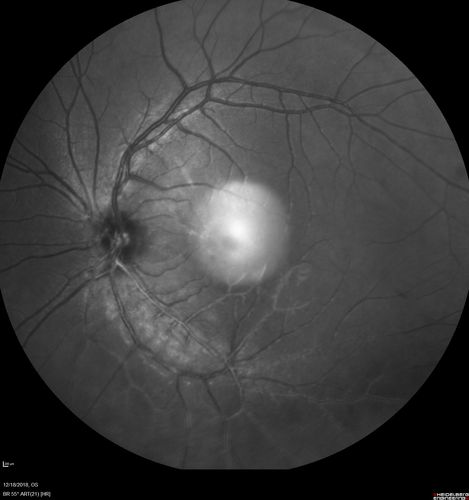White Retinal Artiole Left eye - Inferotemporal
31 year old female with migraines and headaches for the last 12-13 years.  Sometimes she gets the visual symptoms with the migraine.  When she gets the migraines the pain is on the left side of her head.  She gets the problem a few times a month, sometimes more.  They usually last 5-6  hours. She has not had a permanent vision change.  When she gets a vision change there are spotty dots of blue neon lights in her vision.  With her glasses her two eyes are about the same.  VA 20/16 in Each Eye
