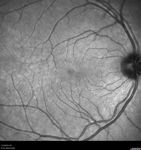 White Retinal Artiole Left eye - Inferotemporal
31 year old female with migraines and headaches for the last 12-13 years.  Sometimes she gets the visual symptoms with the migraine.  When she gets the migraines the pain is on the left side of her head.  She gets the problem a few times a month, sometimes more.  They usually last 5-6  hours. She has not had a permanent vision change.  When she gets a vision change there are spotty dots of blue neon lights in her vision.  With her glasses her two eyes are about the same.  VA 20/16 in Each Eye
