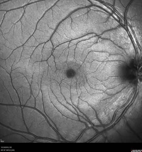 White Retinal Artiole Left eye - Inferotemporal
31 year old female with migraines and headaches for the last 12-13 years.  Sometimes she gets the visual symptoms with the migraine.  When she gets the migraines the pain is on the left side of her head.  She gets the problem a few times a month, sometimes more.  They usually last 5-6  hours. She has not had a permanent vision change.  When she gets a vision change there are spotty dots of blue neon lights in her vision.  With her glasses her two eyes are about the same.  VA 20/16 in Each Eye
