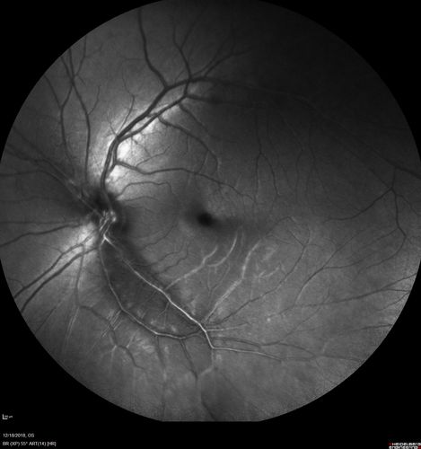 White Retinal Artiole Left eye - Inferotemporal
31 year old female with migraines and headaches for the last 12-13 years.  Sometimes she gets the visual symptoms with the migraine.  When she gets the migraines the pain is on the left side of her head.  She gets the problem a few times a month, sometimes more.  They usually last 5-6  hours. She has not had a permanent vision change.  When she gets a vision change there are spotty dots of blue neon lights in her vision.  With her glasses her two eyes are about the same.  VA 20/16 in Each Eye
