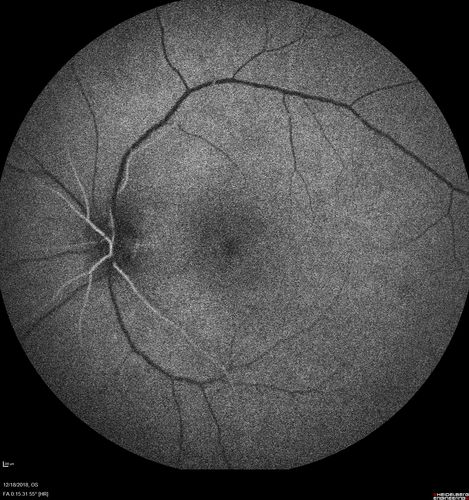 White Retinal Artiole Left eye - Inferotemporal
31 year old female with migraines and headaches for the last 12-13 years.  Sometimes she gets the visual symptoms with the migraine.  When she gets the migraines the pain is on the left side of her head.  She gets the problem a few times a month, sometimes more.  They usually last 5-6  hours. She has not had a permanent vision change.  When she gets a vision change there are spotty dots of blue neon lights in her vision.  With her glasses her two eyes are about the same.  VA 20/16 in Each Eye
