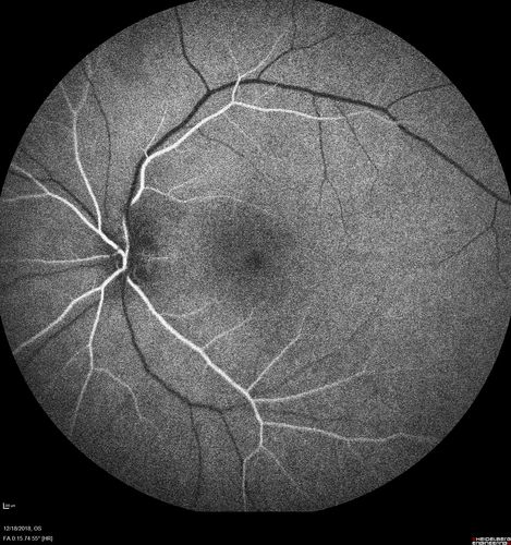 White Retinal Artiole Left eye - Inferotemporal
31 year old female with migraines and headaches for the last 12-13 years.  Sometimes she gets the visual symptoms with the migraine.  When she gets the migraines the pain is on the left side of her head.  She gets the problem a few times a month, sometimes more.  They usually last 5-6  hours. She has not had a permanent vision change.  When she gets a vision change there are spotty dots of blue neon lights in her vision.  With her glasses her two eyes are about the same.  VA 20/16 in Each Eye
