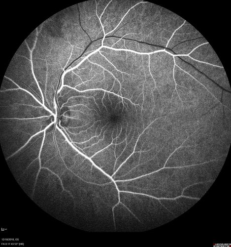 White Retinal Artiole Left eye - Inferotemporal
31 year old female with migraines and headaches for the last 12-13 years.  Sometimes she gets the visual symptoms with the migraine.  When she gets the migraines the pain is on the left side of her head.  She gets the problem a few times a month, sometimes more.  They usually last 5-6  hours. She has not had a permanent vision change.  When she gets a vision change there are spotty dots of blue neon lights in her vision.  With her glasses her two eyes are about the same.  VA 20/16 in Each Eye
