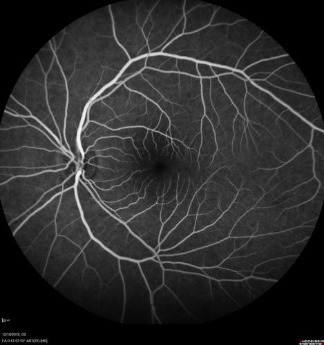 White Retinal Artiole Left eye - Inferotemporal
31 year old female with migraines and headaches for the last 12-13 years.  Sometimes she gets the visual symptoms with the migraine.  When she gets the migraines the pain is on the left side of her head.  She gets the problem a few times a month, sometimes more.  They usually last 5-6  hours. She has not had a permanent vision change.  When she gets a vision change there are spotty dots of blue neon lights in her vision.  With her glasses her two eyes are about the same.  VA 20/16 in Each Eye
