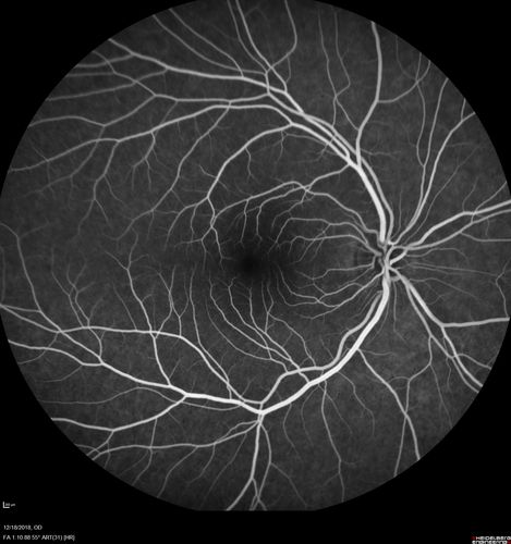 White Retinal Artiole Left eye - Inferotemporal
31 year old female with migraines and headaches for the last 12-13 years.  Sometimes she gets the visual symptoms with the migraine.  When she gets the migraines the pain is on the left side of her head.  She gets the problem a few times a month, sometimes more.  They usually last 5-6  hours. She has not had a permanent vision change.  When she gets a vision change there are spotty dots of blue neon lights in her vision.  With her glasses her two eyes are about the same.  VA 20/16 in Each Eye

