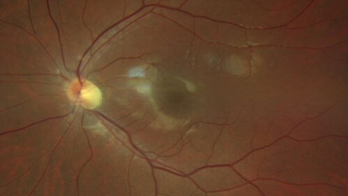 Achromatopsia
28 year old female Good vision since birth started wearing glasses at 2, denies trauma. She does have congenital nystagmus.

VA OD: Dcc20/200-2 PH20/200 NccJ7
VA OS: Dcc20/160 PHNI NccJ7
IOP: TP: OD:15 OS:12
