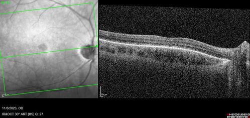 Achromatopsia
28 year old female Good vision since birth started wearing glasses at 2, denies trauma. She does have congenital nystagmus.

VA OD: Dcc20/200-2 PH20/200 NccJ7
VA OS: Dcc20/160 PHNI NccJ7
IOP: TP: OD:15 OS:12
