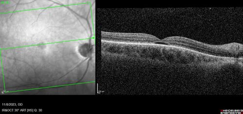 Achromatopsia
28 year old female Good vision since birth started wearing glasses at 2, denies trauma. She does have congenital nystagmus.

VA OD: Dcc20/200-2 PH20/200 NccJ7
VA OS: Dcc20/160 PHNI NccJ7
IOP: TP: OD:15 OS:12
