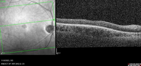 Achromatopsia
28 year old female Good vision since birth started wearing glasses at 2, denies trauma. She does have congenital nystagmus.

VA OD: Dcc20/200-2 PH20/200 NccJ7
VA OS: Dcc20/160 PHNI NccJ7
IOP: TP: OD:15 OS:12
