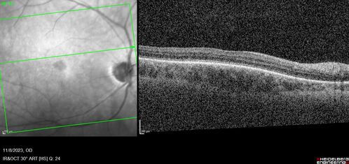 Achromatopsia
28 year old female Good vision since birth started wearing glasses at 2, denies trauma. She does have congenital nystagmus.

VA OD: Dcc20/200-2 PH20/200 NccJ7
VA OS: Dcc20/160 PHNI NccJ7
IOP: TP: OD:15 OS:12

