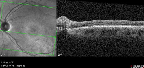 Achromatopsia
28 year old female Good vision since birth started wearing glasses at 2, denies trauma. She does have congenital nystagmus.

VA OD: Dcc20/200-2 PH20/200 NccJ7
VA OS: Dcc20/160 PHNI NccJ7
IOP: TP: OD:15 OS:12
