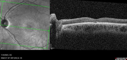 Achromatopsia
28 year old female Good vision since birth started wearing glasses at 2, denies trauma. She does have congenital nystagmus.

VA OD: Dcc20/200-2 PH20/200 NccJ7
VA OS: Dcc20/160 PHNI NccJ7
IOP: TP: OD:15 OS:12

