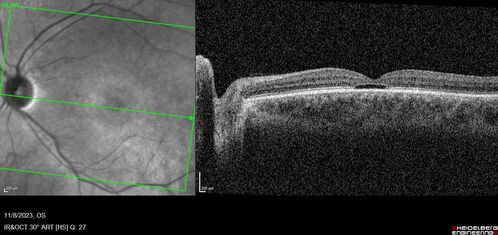 Achromatopsia
28 year old female Good vision since birth started wearing glasses at 2, denies trauma. She does have congenital nystagmus.

VA OD: Dcc20/200-2 PH20/200 NccJ7
VA OS: Dcc20/160 PHNI NccJ7
IOP: TP: OD:15 OS:12
