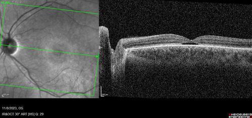 Achromatopsia
28 year old female Good vision since birth started wearing glasses at 2, denies trauma. She does have congenital nystagmus.

VA OD: Dcc20/200-2 PH20/200 NccJ7
VA OS: Dcc20/160 PHNI NccJ7
IOP: TP: OD:15 OS:12
