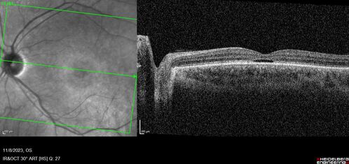 Achromatopsia
28 year old female Good vision since birth started wearing glasses at 2, denies trauma. She does have congenital nystagmus.

VA OD: Dcc20/200-2 PH20/200 NccJ7
VA OS: Dcc20/160 PHNI NccJ7
IOP: TP: OD:15 OS:12
