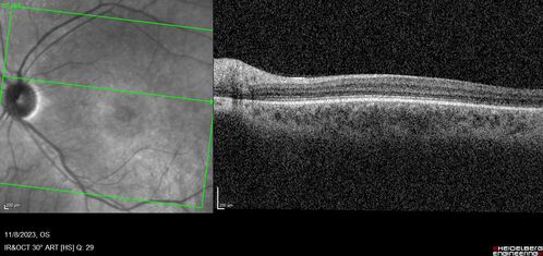 Achromatopsia
28 year old female Good vision since birth started wearing glasses at 2, denies trauma. She does have congenital nystagmus.

VA OD: Dcc20/200-2 PH20/200 NccJ7
VA OS: Dcc20/160 PHNI NccJ7
IOP: TP: OD:15 OS:12
