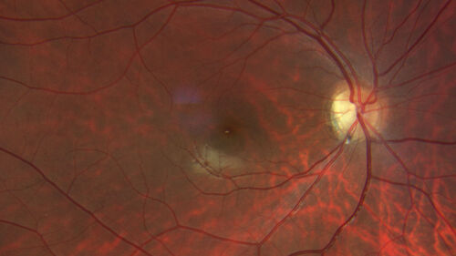 Autosomal Dominant Optic Atrophy - OPA1 Mutation
25 year old  female with VA 20/80 OU and recent vision decline.  Her father also has poor vision.

