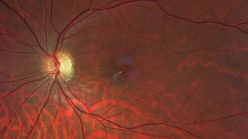 Autosomal Dominant Optic Atrophy - OPA1 Mutation
25 year old  female with VA 20/80 OU and recent vision decline.  Her father also has poor vision.
