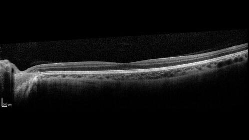 Autosomal Dominant Optic Atrophy - OPA1 Mutation
25 year old  female with VA 20/80 OU and recent vision decline.  Her father also has poor vision.
