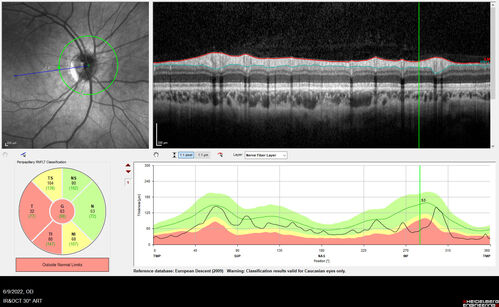 Autosomal Dominant Optic Atrophy - OPA1 Mutation
25 year old  female with VA 20/80 OU and recent vision decline.  Her father also has poor vision.
