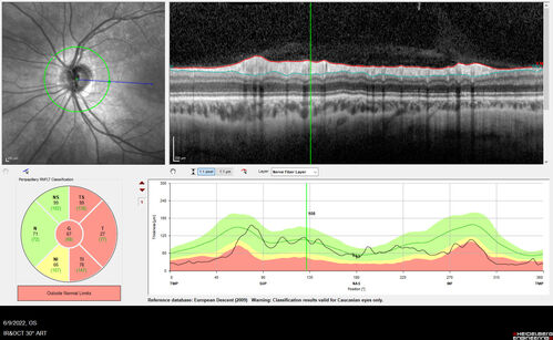 Autosomal Dominant Optic Atrophy - OPA1 Mutation
25 year old  female with VA 20/80 OU and recent vision decline.  Her father also has poor vision.

