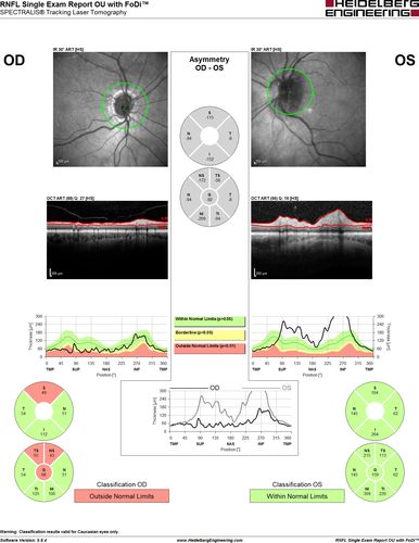 Acute non arteritic anterior ischemic optic neuropathy left eye - RNFL shows some atrophy in the fellow eye
66 y.o. woman spot in central vision in left eye started about 1 week ago since then it is not changing. VA OD: sc20/25 OS: sc20/200 
