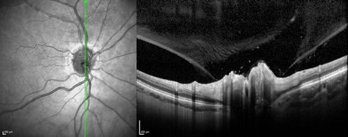 Acute non arteritic anterior ischemic optic neuropathy left eye - SD Optical Coherence Tomography Line Scan
66 y.o. woman spot in central vision in left eye started about 1 week ago since then it is not changing. VA OD: sc20/25 OS: sc20/200 

