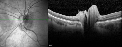 Acute non arteritic anterior ischemic optic neuropathy left eye - SD Optical Coherence Tomography Line Scan
66 y.o. woman spot in central vision in left eye started about 1 week ago since then it is not changing. VA OD: sc20/25 OS: sc20/200 
