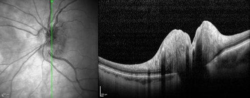 Acute non arteritic anterior ischemic optic neuropathy left eye - SD Optical Coherence Tomography Line Scan
66 y.o. woman spot in central vision in left eye started about 1 week ago since then it is not changing. VA OD: sc20/25 OS: sc20/200 
