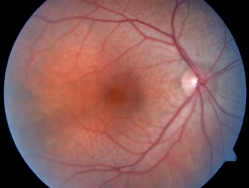 Non-arteritic Anterior Ischemic Optic Neuropathy following Intravitreal Injection 
81-year-old woman has had injections in both eyes for wet age-related macular degeneration.  2 weeks ago the left eye was treated. Less than a week ago she noticed a change in vision in the left eye.  She had a dull left frontal headache and noticed her vision was hazy as if there was a veil over the vision. OD is 20/25, OS is 20/25.  IOP:  OD 18, OS 26.  The left eye has a 3+ APD
