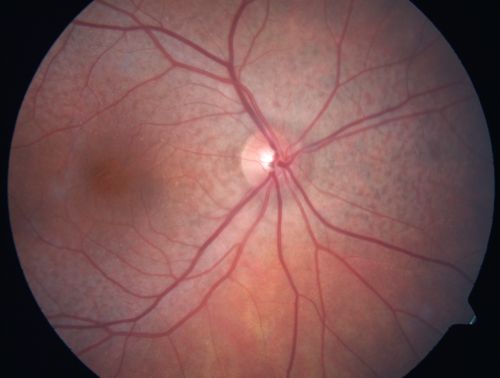 Non-arteritic Anterior Ischemic Optic Neuropathy following Intravitreal Injection - Fellow eye - Reticular Pseudodrusen - Reticular Macular Disease
81-year-old woman has had injections in both eyes for wet age-related macular degeneration.  2 weeks ago the left eye was treated. Less than a week ago she noticed a change in vision in the left eye.  She had a dull left frontal headache and noticed her vision was hazy as if there was a veil over the vision. OD is 20/25, OS is 20/25.  IOP:  OD 18, OS 26.  The left eye has a 3+ APD
