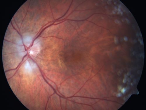 Non-arteritic Anterior Ischemic Optic Neuropathy following Intravitreal Injection 
81-year-old woman has had injections in both eyes for wet age-related macular degeneration.  2 weeks ago the left eye was treated. Less than a week ago she noticed a change in vision in the left eye.  She had a dull left frontal headache and noticed her vision was hazy as if there was a veil over the vision. OD is 20/25, OS is 20/25.  IOP:  OD 18, OS 26.  The left eye has a 3+ APD
