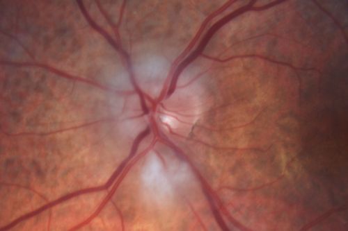 Non-arteritic Anterior Ischemic Optic Neuropathy following Intravitreal Injection 
81-year-old woman has had injections in both eyes for wet age-related macular degeneration.  2 weeks ago the left eye was treated. Less than a week ago she noticed a change in vision in the left eye.  She had a dull left frontal headache and noticed her vision was hazy as if there was a veil over the vision. OD is 20/25, OS is 20/25.  IOP:  OD 18, OS 26.  The left eye has a 3+ APD
