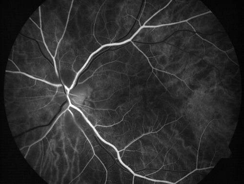 Non-arteritic Anterior Ischemic Optic Neuropathy following Intravitreal Injection 
81-year-old woman has had injections in both eyes for wet age-related macular degeneration.  2 weeks ago the left eye was treated. Less than a week ago she noticed a change in vision in the left eye.  She had a dull left frontal headache and noticed her vision was hazy as if there was a veil over the vision. OD is 20/25, OS is 20/25.  IOP:  OD 18, OS 26.  The left eye has a 3+ APD
