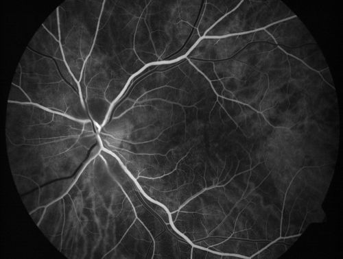 Non-arteritic Anterior Ischemic Optic Neuropathy following Intravitreal Injection 
81-year-old woman has had injections in both eyes for wet age-related macular degeneration.  2 weeks ago the left eye was treated. Less than a week ago she noticed a change in vision in the left eye.  She had a dull left frontal headache and noticed her vision was hazy as if there was a veil over the vision. OD is 20/25, OS is 20/25.  IOP:  OD 18, OS 26.  The left eye has a 3+ APD
