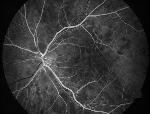 Non-arteritic Anterior Ischemic Optic Neuropathy following Intravitreal Injection 
81-year-old woman has had injections in both eyes for wet age-related macular degeneration.  2 weeks ago the left eye was treated. Less than a week ago she noticed a change in vision in the left eye.  She had a dull left frontal headache and noticed her vision was hazy as if there was a veil over the vision. OD is 20/25, OS is 20/25.  IOP:  OD 18, OS 26.  The left eye has a 3+ APD
