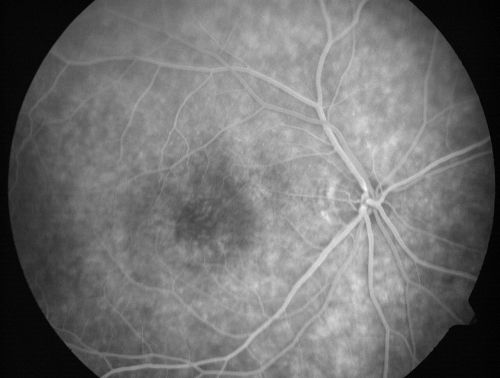 Non-arteritic Anterior Ischemic Optic Neuropathy following Intravitreal Injection 
81-year-old woman has had injections in both eyes for wet age-related macular degeneration.  2 weeks ago the left eye was treated. Less than a week ago she noticed a change in vision in the left eye.  She had a dull left frontal headache and noticed her vision was hazy as if there was a veil over the vision. OD is 20/25, OS is 20/25.  IOP:  OD 18, OS 26.  The left eye has a 3+ APD
