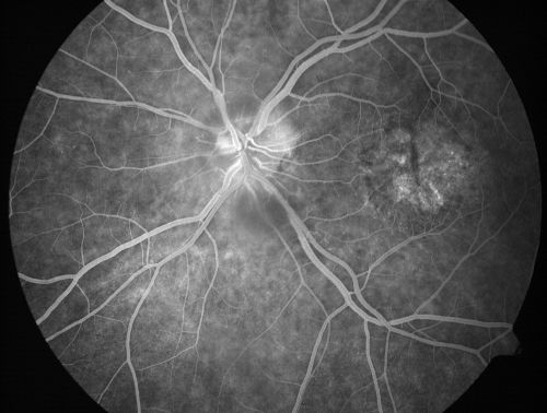 Non-arteritic Anterior Ischemic Optic Neuropathy following Intravitreal Injection 
81-year-old woman has had injections in both eyes for wet age-related macular degeneration.  2 weeks ago the left eye was treated. Less than a week ago she noticed a change in vision in the left eye.  She had a dull left frontal headache and noticed her vision was hazy as if there was a veil over the vision. OD is 20/25, OS is 20/25.  IOP:  OD 18, OS 26.  The left eye has a 3+ APD
