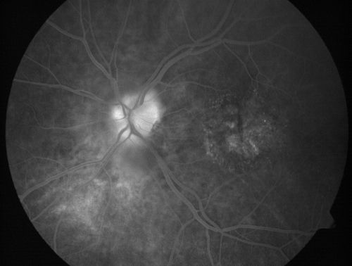 Non-arteritic Anterior Ischemic Optic Neuropathy following Intravitreal Injection 
81-year-old woman has had injections in both eyes for wet age-related macular degeneration.  2 weeks ago the left eye was treated. Less than a week ago she noticed a change in vision in the left eye.  She had a dull left frontal headache and noticed her vision was hazy as if there was a veil over the vision. OD is 20/25, OS is 20/25.  IOP:  OD 18, OS 26.  The left eye has a 3+ APD
