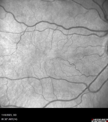 Albinism and Renal failure - Possible Hermansky-Pudlak Syndrome
65 year old female with foveal hypoplasia and renal failure since age 18.  VA 20/40 OD, 20/63 OS
