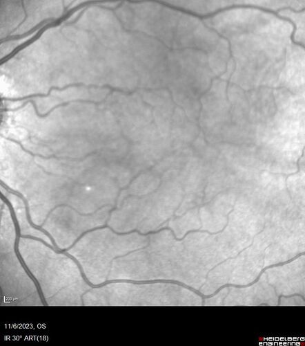 Albinism and Renal failure - Possible Hermansky-Pudlak Syndrome
65 year old female with foveal hypoplasia and renal failure since age 18.  VA 20/40 OD, 20/63 OS
