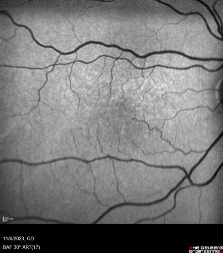 Albinism and Renal failure - Possible Hermansky-Pudlak Syndrome
65 year old female with foveal hypoplasia and renal failure since age 18.  VA 20/40 OD, 20/63 OS
