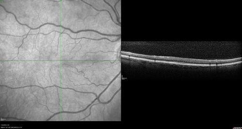 Albinism and Renal failure - Possible Hermansky-Pudlak Syndrome
65 year old female with foveal hypoplasia and renal failure since age 18.  VA 20/40 OD, 20/63 OS
