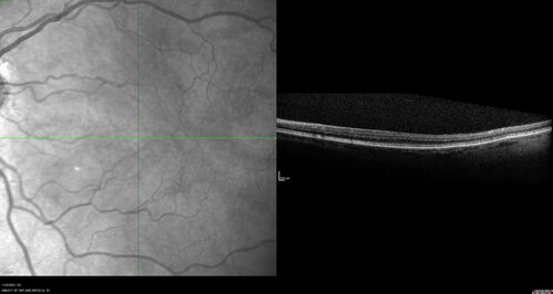 Albinism and Renal failure - Possible Hermansky-Pudlak Syndrome
65 year old female with foveal hypoplasia and renal failure since age 18.  VA 20/40 OD, 20/63 OS

