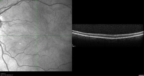Albinism and Renal failure - Possible Hermansky-Pudlak Syndrome
65 year old female with foveal hypoplasia and renal failure since age 18.  VA 20/40 OD, 20/63 OS
